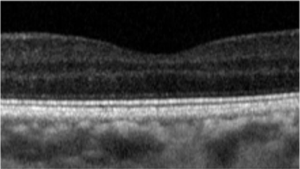 Retinal Image